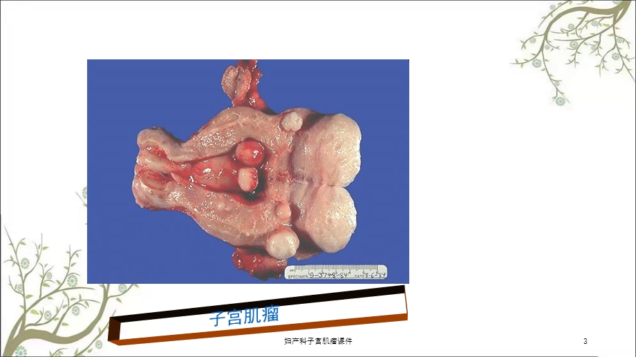 妇产科子宫肌瘤课件.ppt_第3页