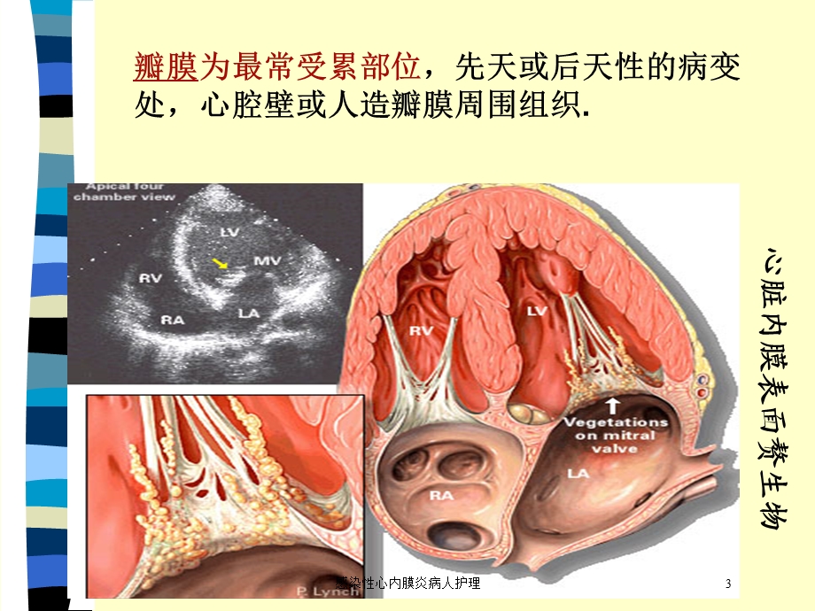 感染性心内膜炎病人护理培训课件.ppt_第3页