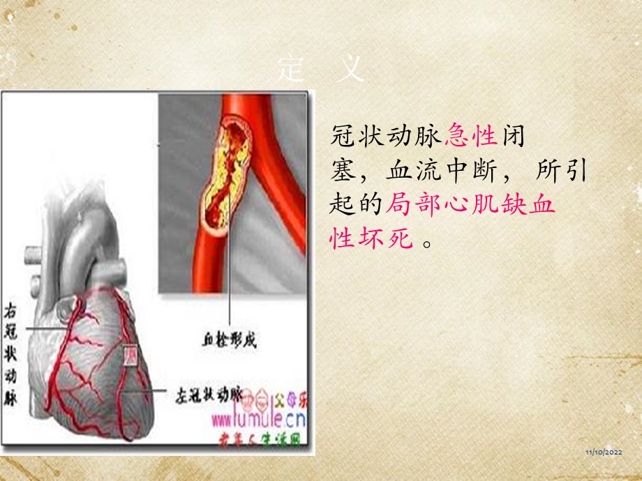 急性心肌梗死及护理课件.pptx_第3页