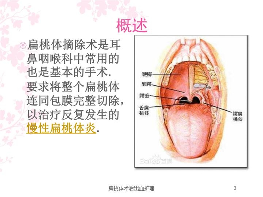 扁桃体术后出血护理培训课件.ppt_第3页