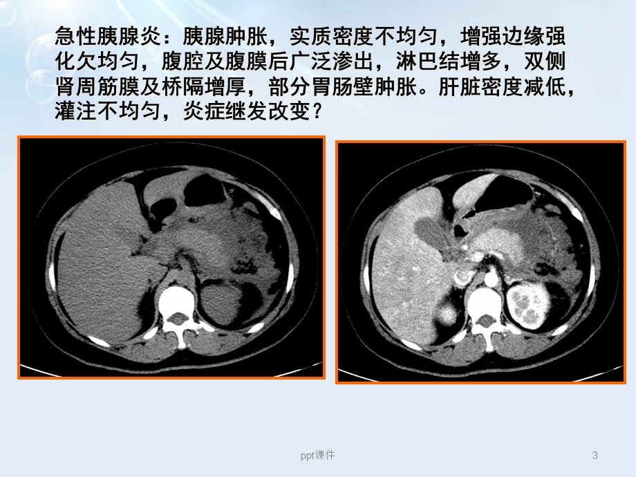 急性胰腺炎液体复苏课件.ppt_第3页