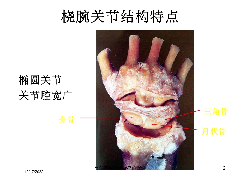 尺骨茎突骨折治疗的探讨课件.ppt_第2页