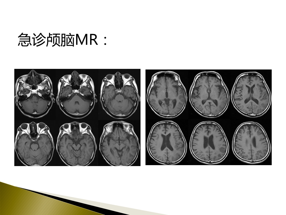 大面积脑梗死的诊断及治疗课件.ppt_第3页