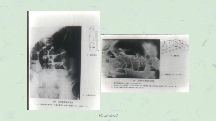 急腹症的X线诊断课件.ppt_第3页