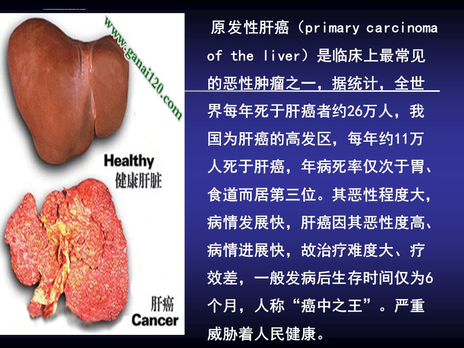 放射性粒子治疗肝癌ppt课件.ppt_第3页