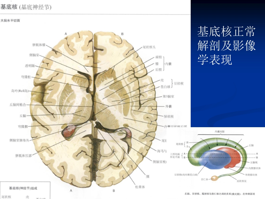 大脑深部对称性灰质核团病变的病因与mri诊断课件.pptx_第3页
