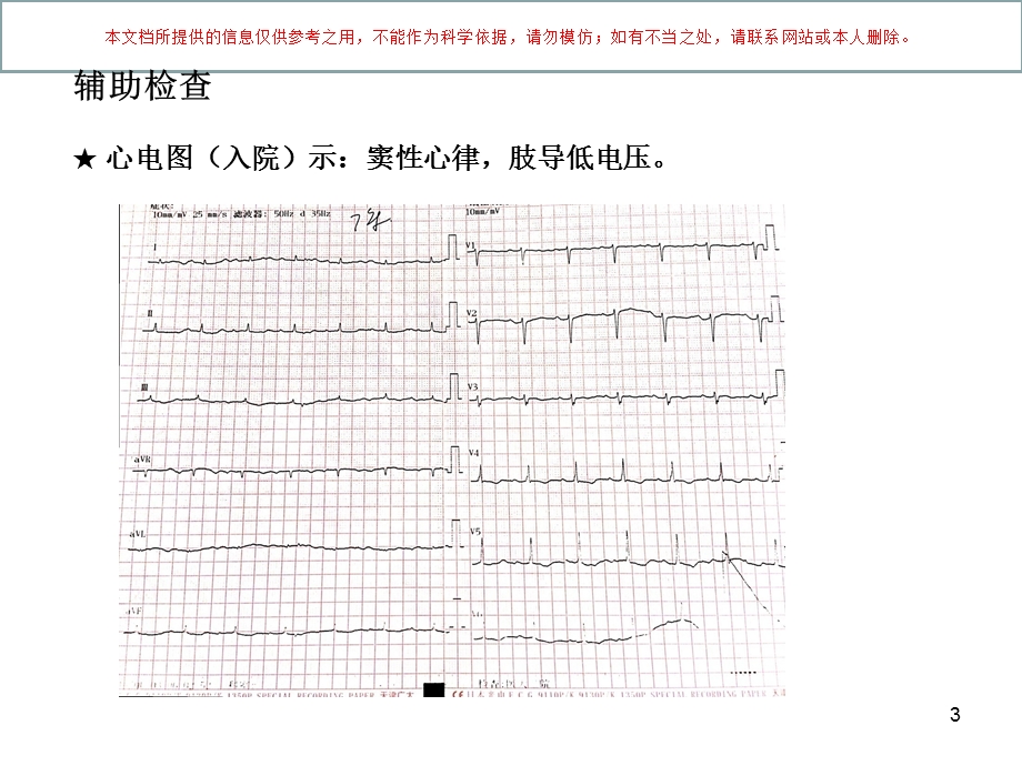 淀粉样变性心肌病一例培训课件.ppt_第3页