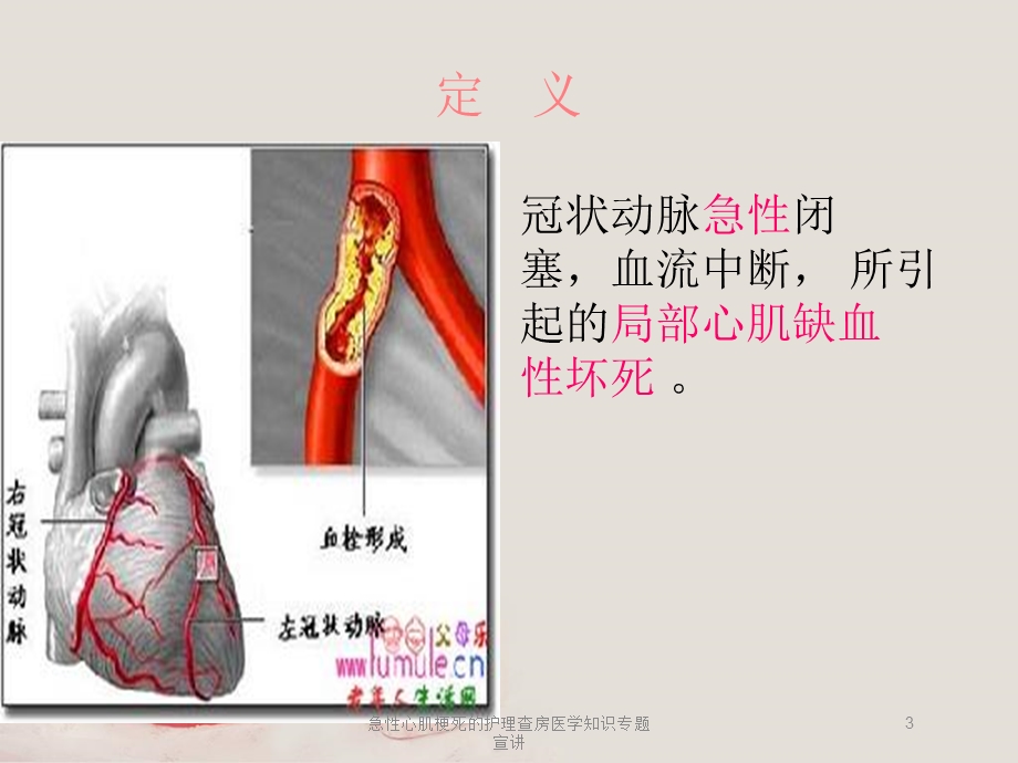 急性心肌梗死的护理查房医学知识专题宣讲培训课件.ppt_第3页