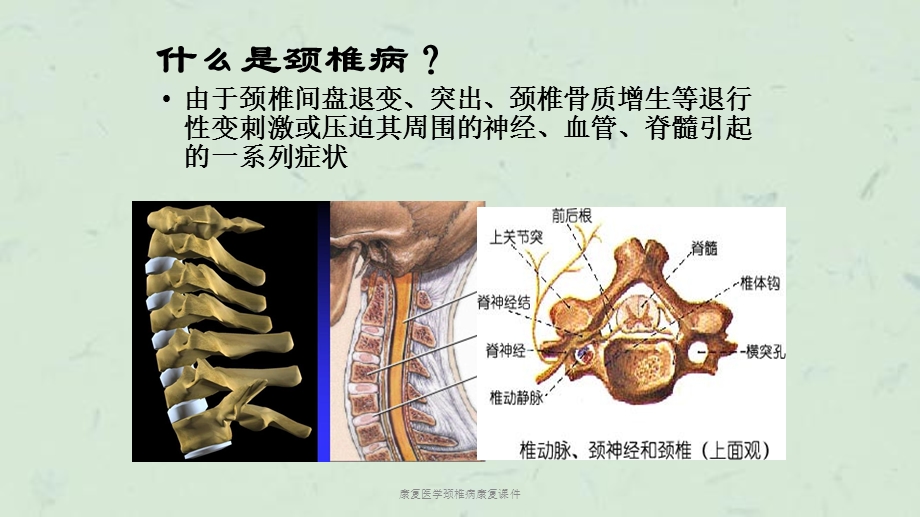 康复医学颈椎病康复课件.ppt_第3页