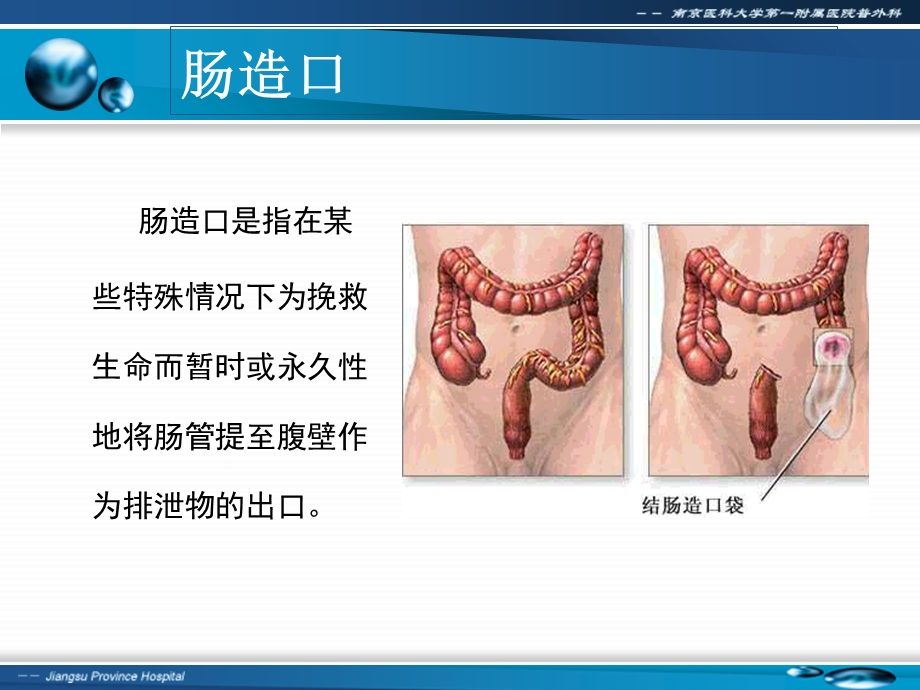 肠造口术前定位ppt课件.ppt_第3页