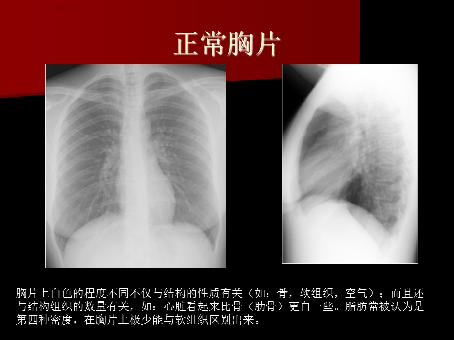 胸片入门及常见胸片的解读ppt课件.ppt_第3页