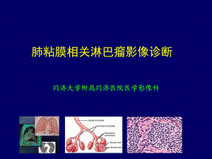 肺粘膜相关淋巴瘤影像特征ppt课件.pptx