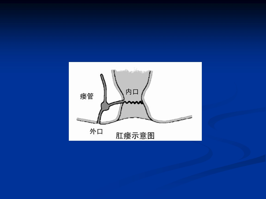 《肛瘘手术》PPT课件.ppt_第3页