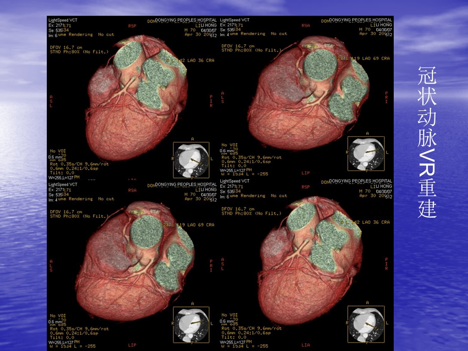 《血管cta实践用》ppt课件.ppt_第3页