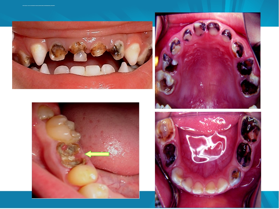 儿童口腔保健及不良习惯ppt课件.ppt_第3页