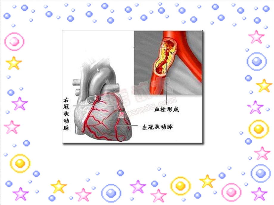 急性心肌梗死诊断治疗及护理标准课件.ppt_第3页