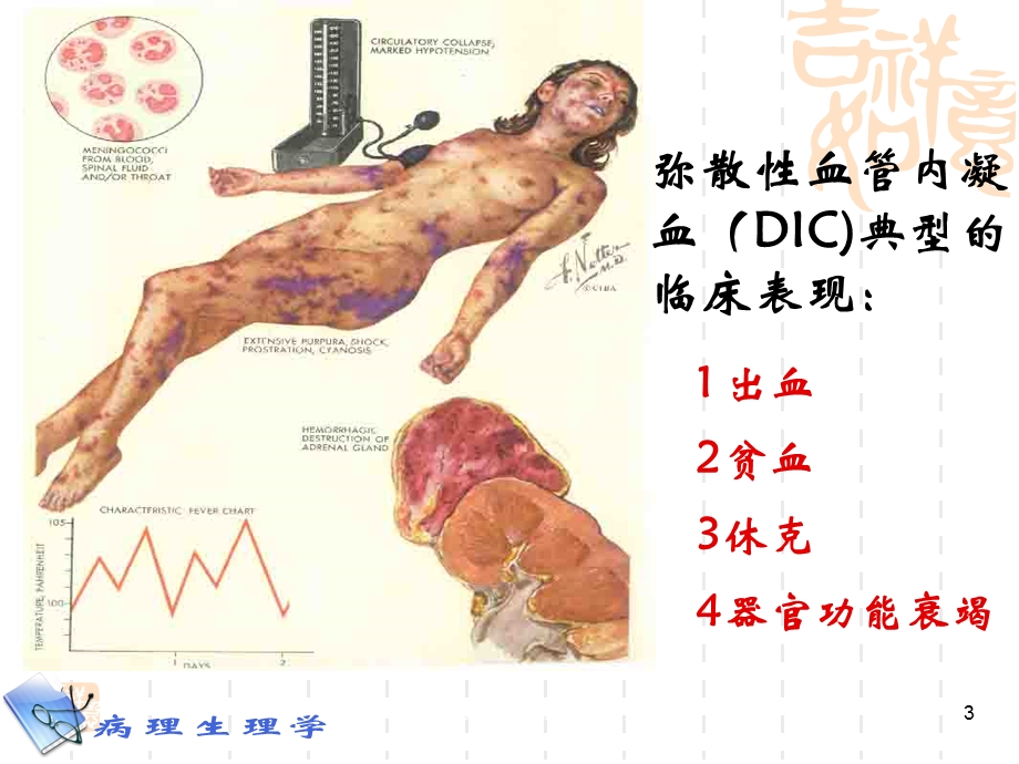 病理生理学凝血和抗凝血平衡紊乱培训课件.ppt_第3页