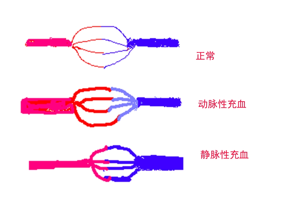 病理学第三章局部血液循环障碍培训课件.ppt_第3页