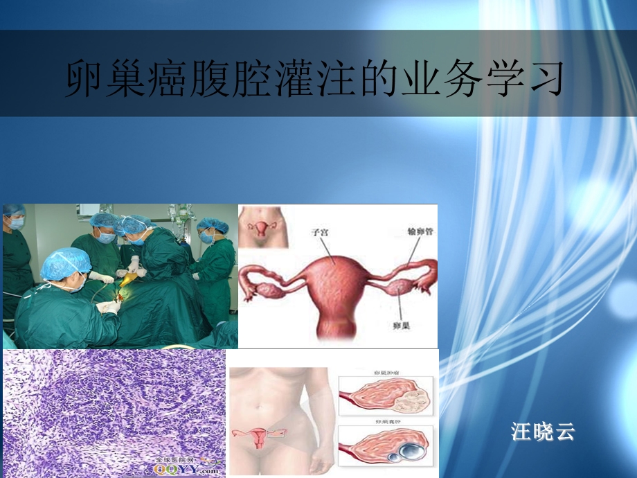 卵巢癌腹腔灌注化疗护理ppt课件.ppt_第1页