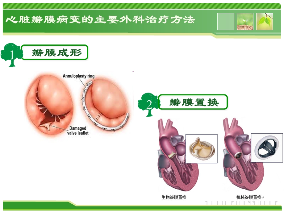 心脏瓣膜成形术ppt课件.ppt_第3页