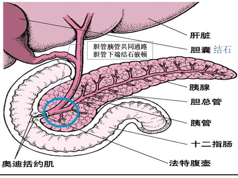 急性重症胰腺炎的护理新进展ppt课件.ppt_第3页