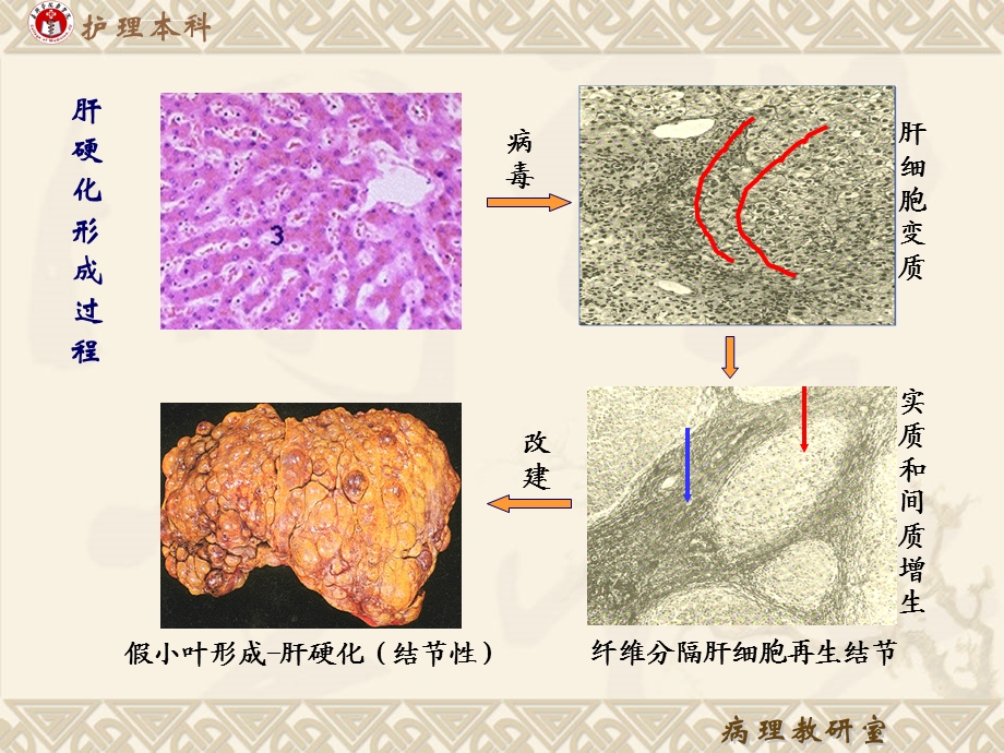 病理学肝硬化肝癌精品ppt课件.ppt_第2页