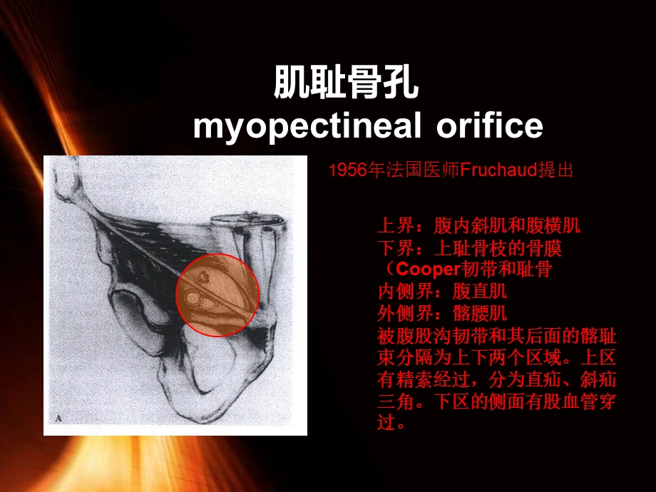 腹腔镜腹股沟疝ppt课件.ppt_第2页