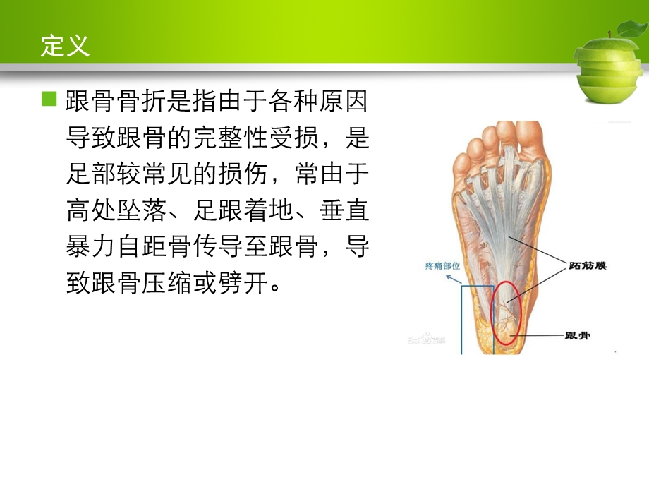 跟骨骨折护理查房ppt课件.pptx_第2页