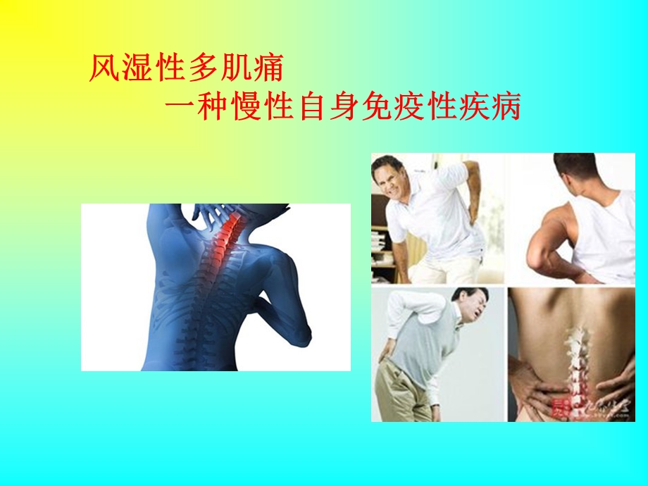 风湿性多肌痛的诊断与治疗详解ppt课件.ppt_第2页