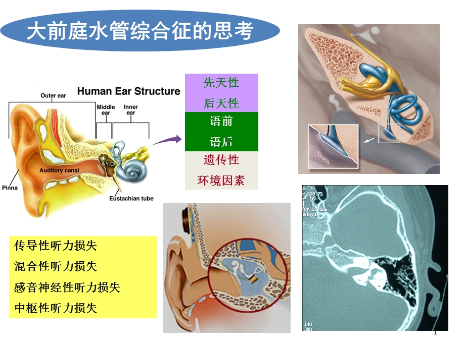 大前庭水管综合征的诊治课件.ppt_第1页