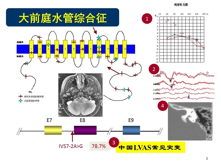 大前庭水管综合征的诊治课件.ppt_第2页