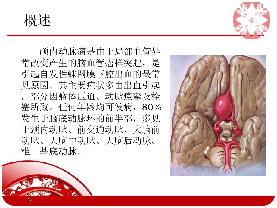 动脉瘤课件.ppt_第3页