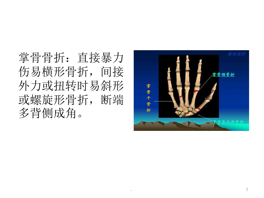 掌骨骨折课件.ppt_第3页