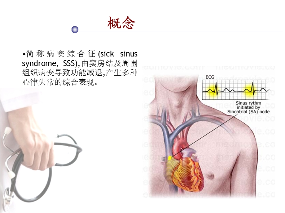 病态窦房结综合征课件.ppt_第2页