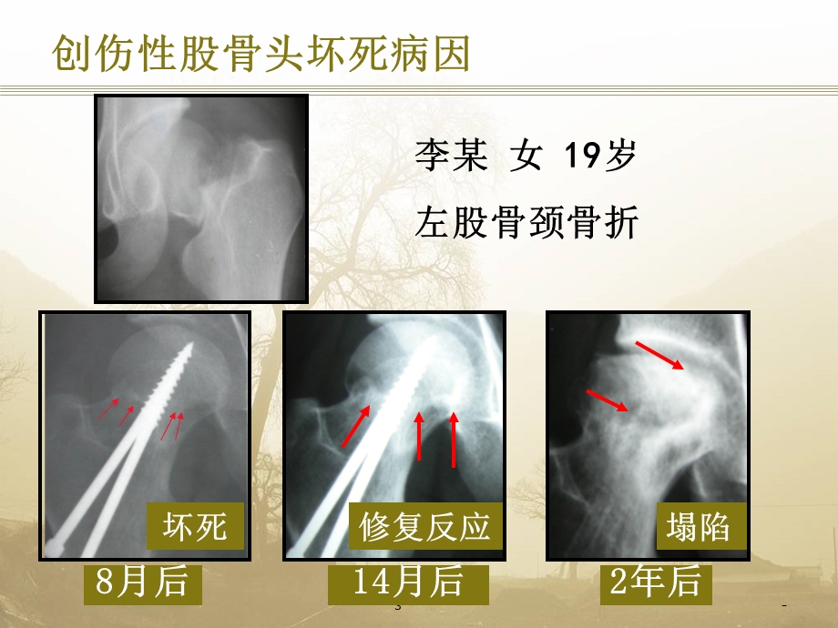 股骨头坏死(定义)课件.ppt_第3页