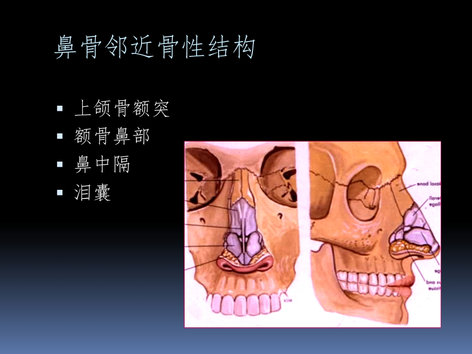 鼻骨骨折影像鉴别诊断课件.ppt_第3页