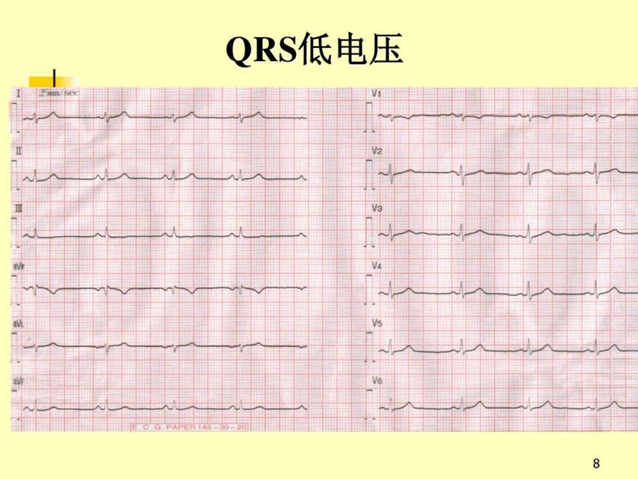 《心电图经典教案》课件.ppt_第3页