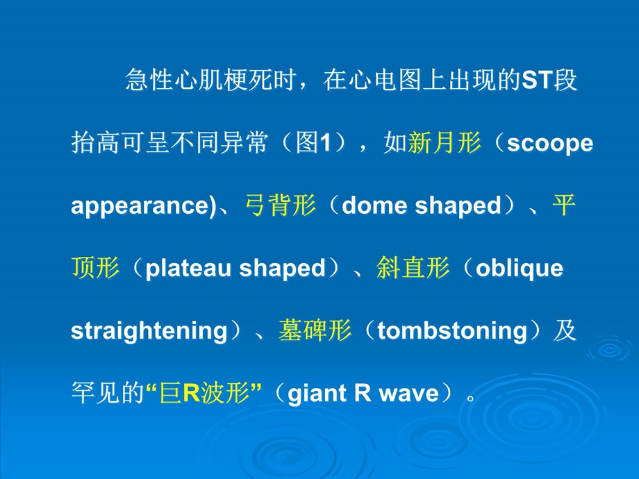 “巨R波形”ST段抬高的特性及其临床意义课件.ppt_第3页