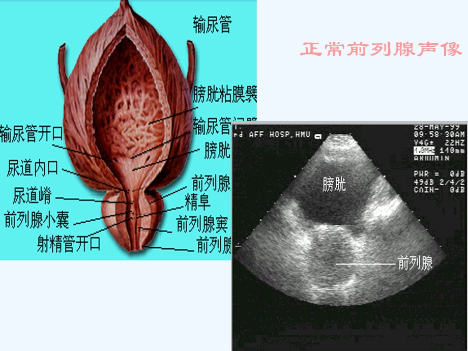 前列腺等超声诊断课件.ppt_第3页