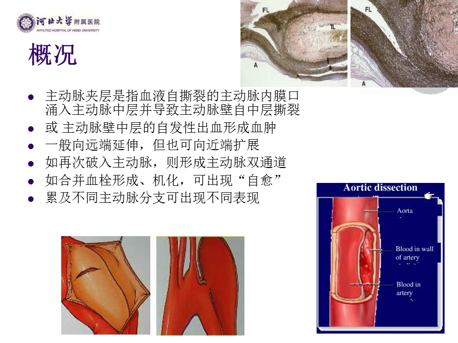 主动脉夹层的诊治ppt课件.ppt_第2页