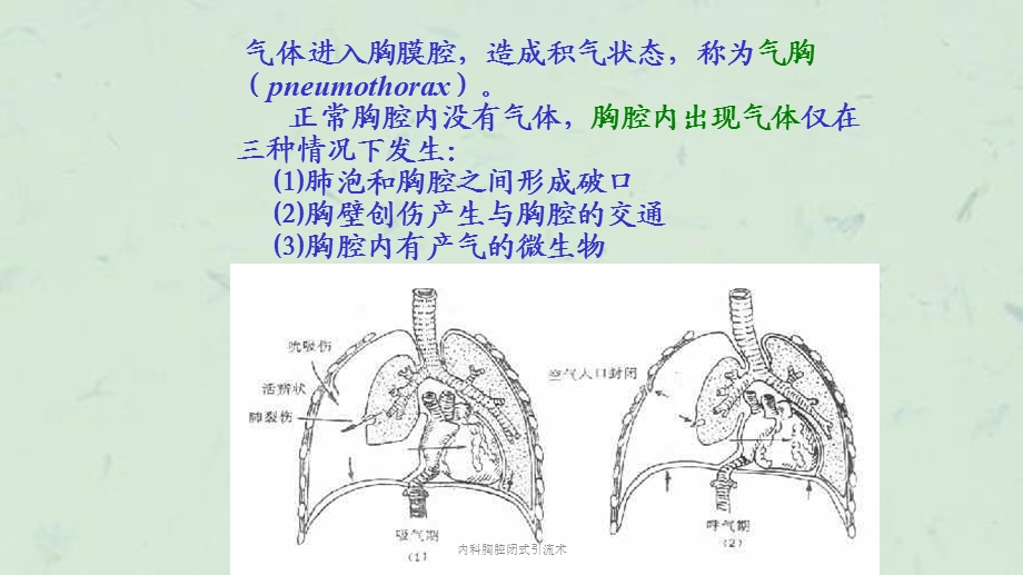 内科胸腔闭式引流术课件.ppt_第3页