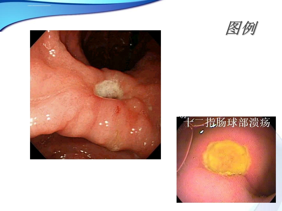 十二指肠球部溃疡ppt课件.ppt_第3页