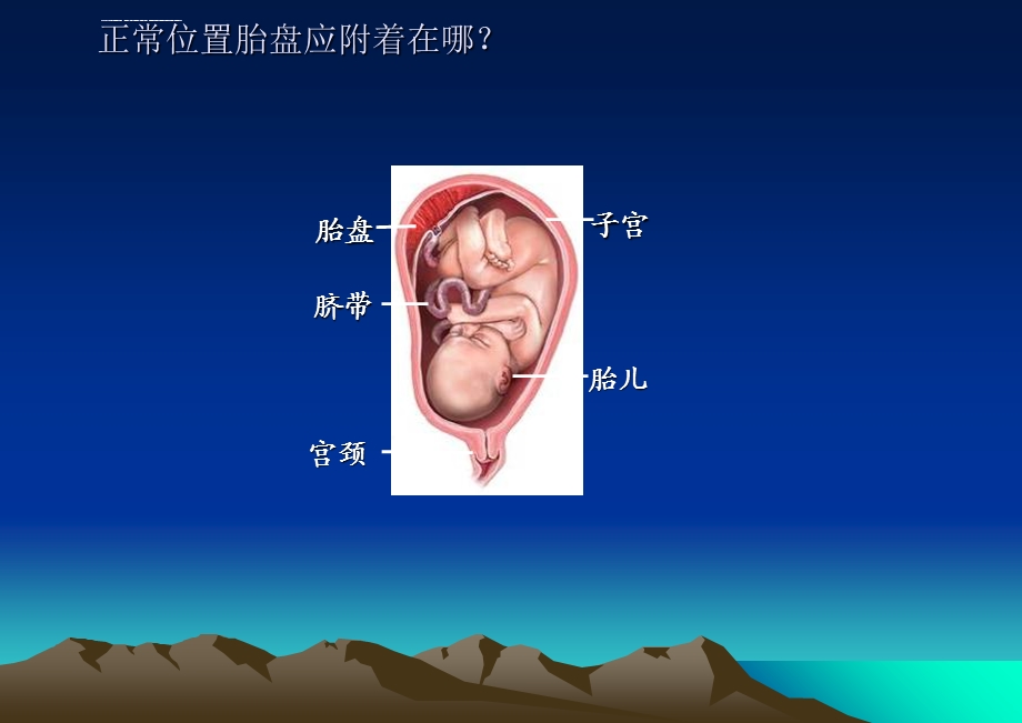 前置胎盘教学查房ppt课件.ppt_第3页