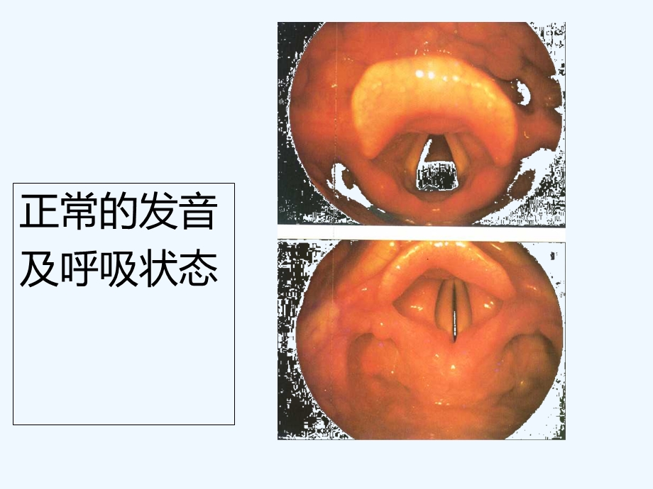 喉阻塞病人护理课件.ppt_第2页