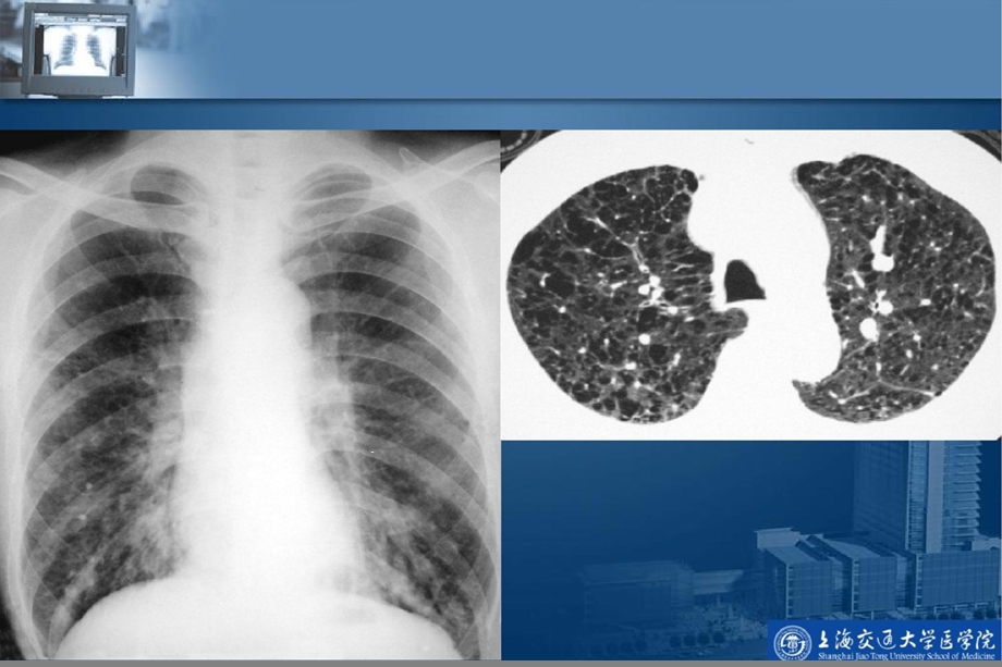 呼吸系统影像学诊断课件.pptx_第3页