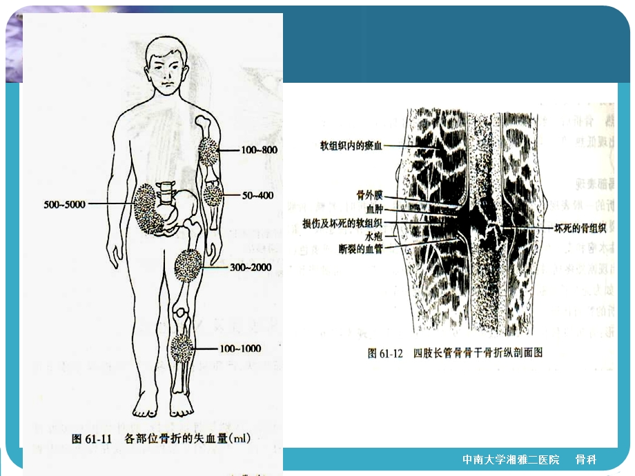 四肢骨折经典ppt课件.ppt_第3页