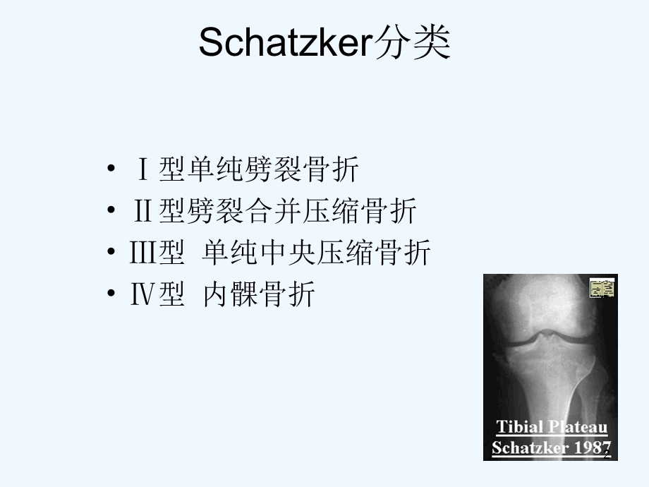 复杂胫骨平台骨折治疗课件.ppt_第2页