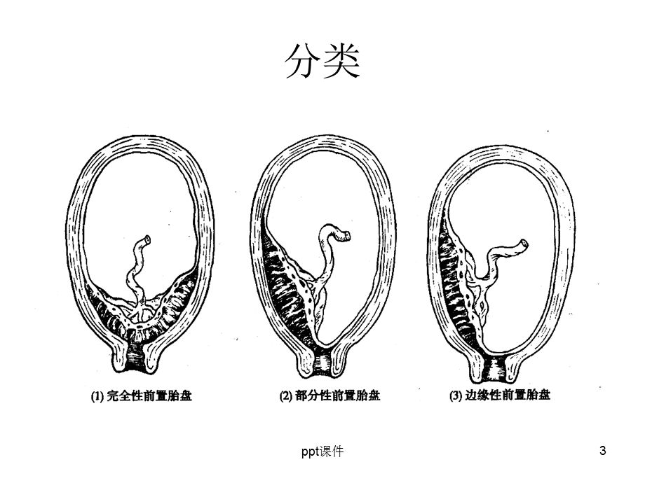 前置胎盘护理课件.ppt_第3页