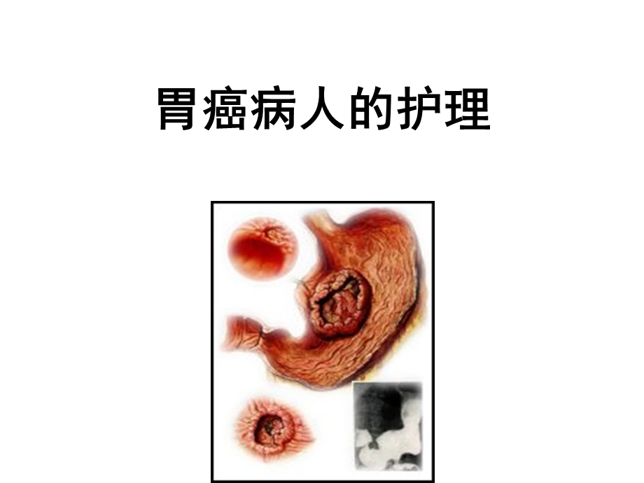 内科护理学ppt课件 胃癌护理.ppt_第1页