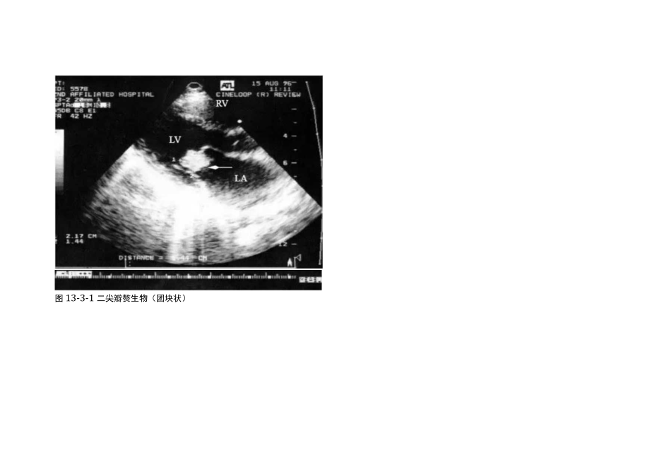 感染性心内膜炎的七大超声心动图表现.docx_第2页